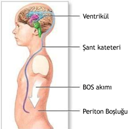 ventriküloperitoneal şant