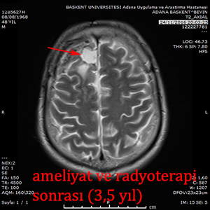 astrositom postop kadir tufan