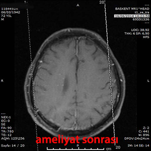 beyin metastazı ameliyat sonrası