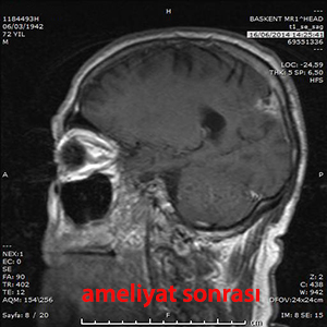 beyin metastazı ameliyat sonrası