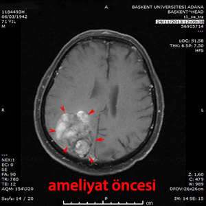 beyin metastazı ameliyat öncesi