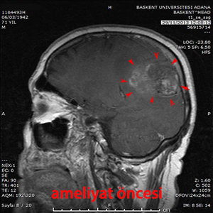 beyin metastazı ameliyat öncesi