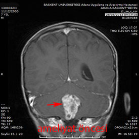 serebellar ependimom preop 3