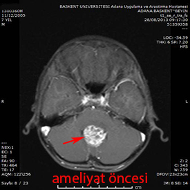 serebellar ependimom preop