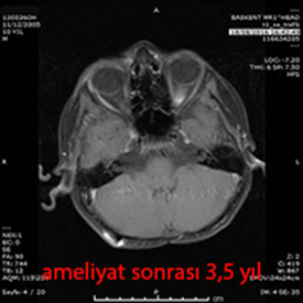 serebellar ependimom postop