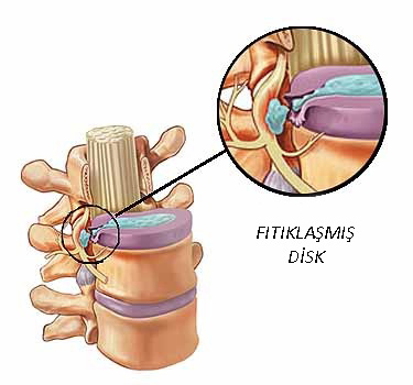 bel fıtığı