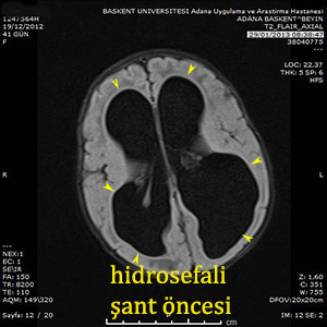 hidrosefali