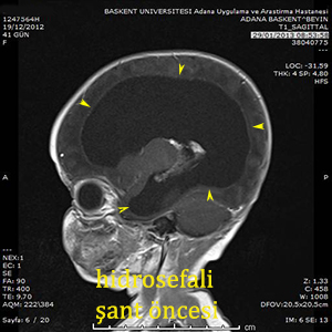 hidrosefali
