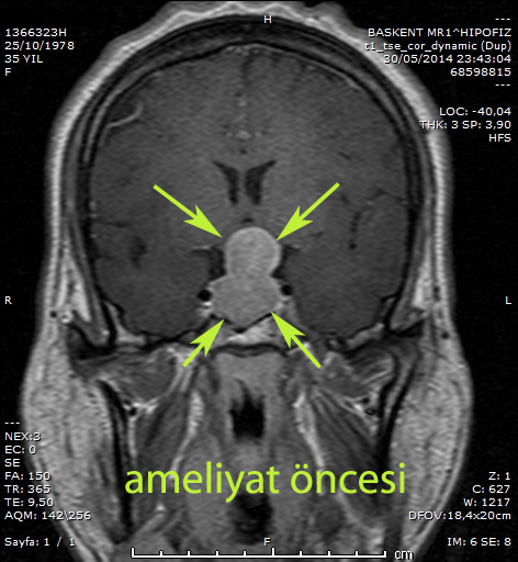 hipofiz adenomu preop kadir tufan