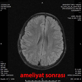 stereotaksik cerrahi kavernom postop 2