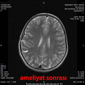 stereotaksik cerrahi kavernom postop