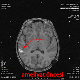 stereotaksik biyopsi kavernom 2