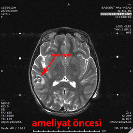 kavernom  preop t2