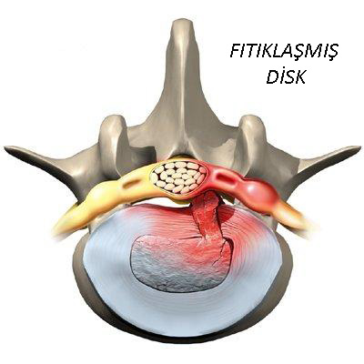 bel fıtığı