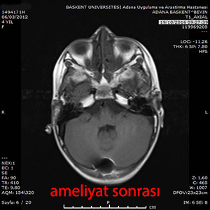 medulloblastom ameliyattan sonra