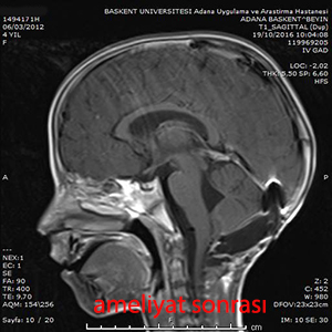 medulloblastom ameliyat sonrası