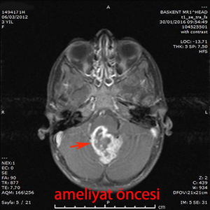 medulloblastom ameliyat öncesi