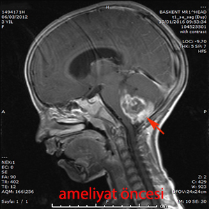 medulloblastom ameliyat öncesi