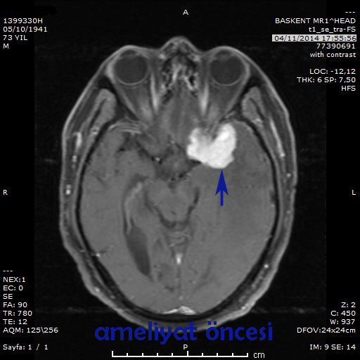 menengioma preop