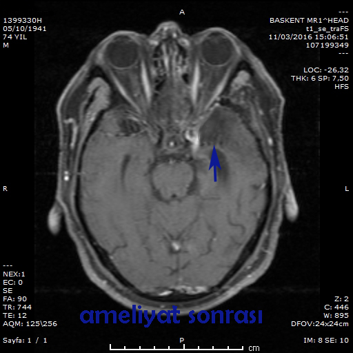 menengioma postop