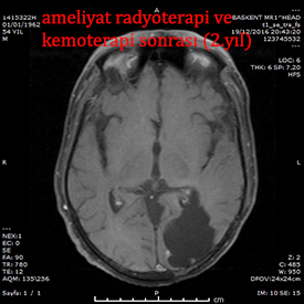 glioblastoma postop kadir tufan