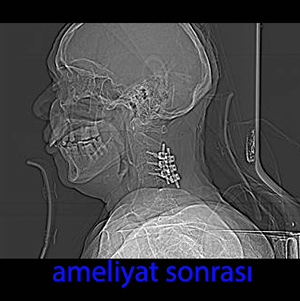 lateral mass vidası