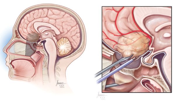 transsfenoidal cerrahi