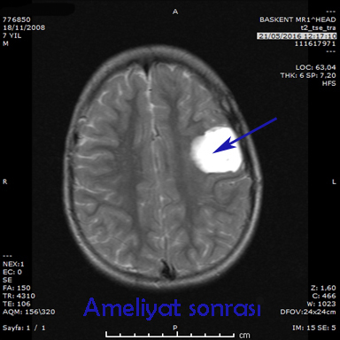 nöronavigasyon ile beyin ameliyatı