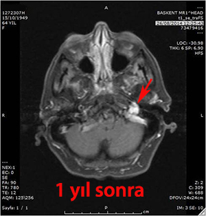 glomus jugulare  gamma knife 1.yıl