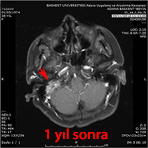 glomus jugulare gamma knife