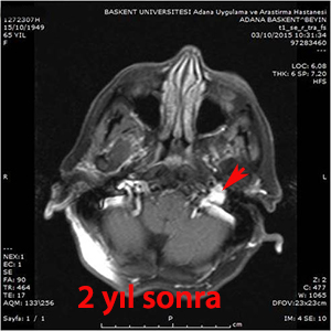 glomus jugulare gamma knife 2.yıl