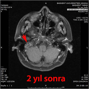 glomus jugulare gamma knife