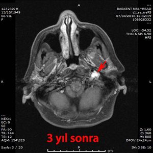 glomus jugulare gamma knife 3. yıl