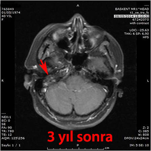 glomus jugulare gamma knife