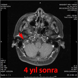 glomus jugulare gamma knife