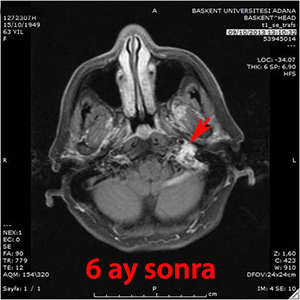 glomus jugulare gamma knife 6. ay