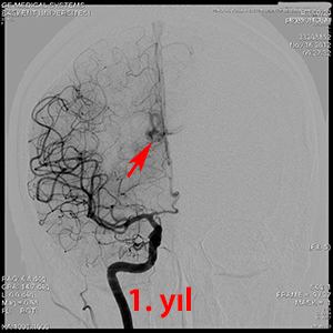 gamma knife avm