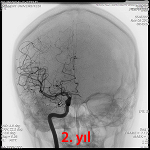 gamma knife avm