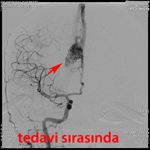 gamma knife avm