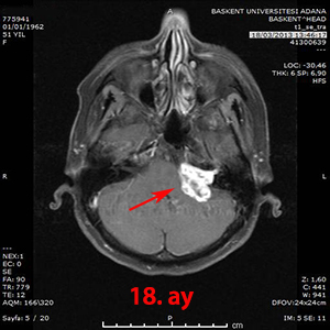 gamma knife schwannoma