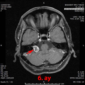 gamma knife akustik