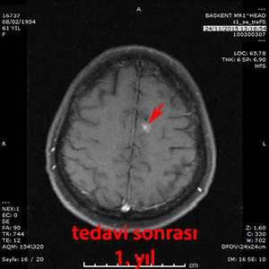 gamma knife metastaz