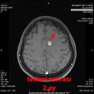 gamma knife metastaz