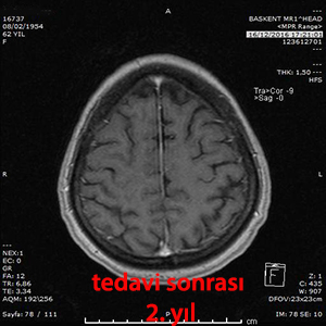 gamma knife metastaz
