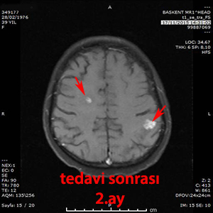 gamma knife multiple metastaz