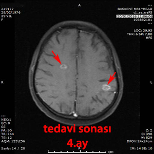 gamma knife multiple metastaz