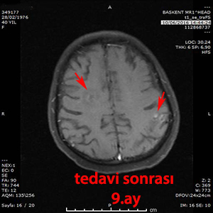 gamma knife multiple metastaz