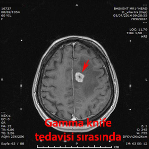 gamma knife metastaz