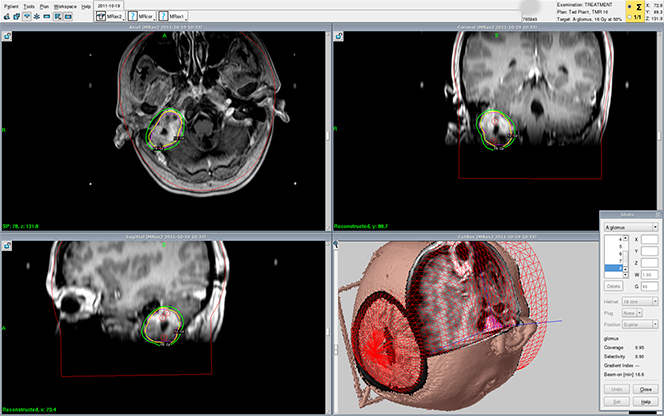 glomus jugulare gamma knife 