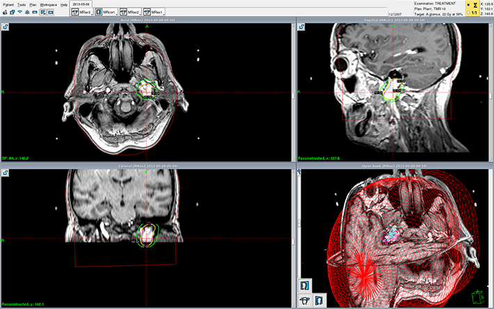 glomus jugulare gamma knife